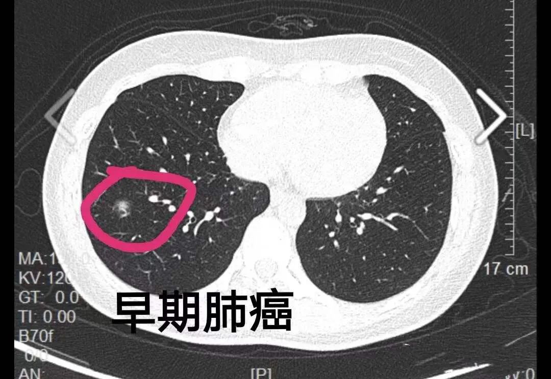 1个月4例!入院筛查没查出新冠,却查出早期肺癌!
