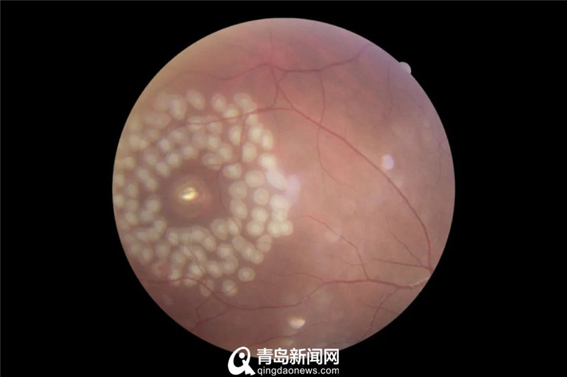 看着就疼注射器冲洗双眼不料针头扎进眼球1厘米深